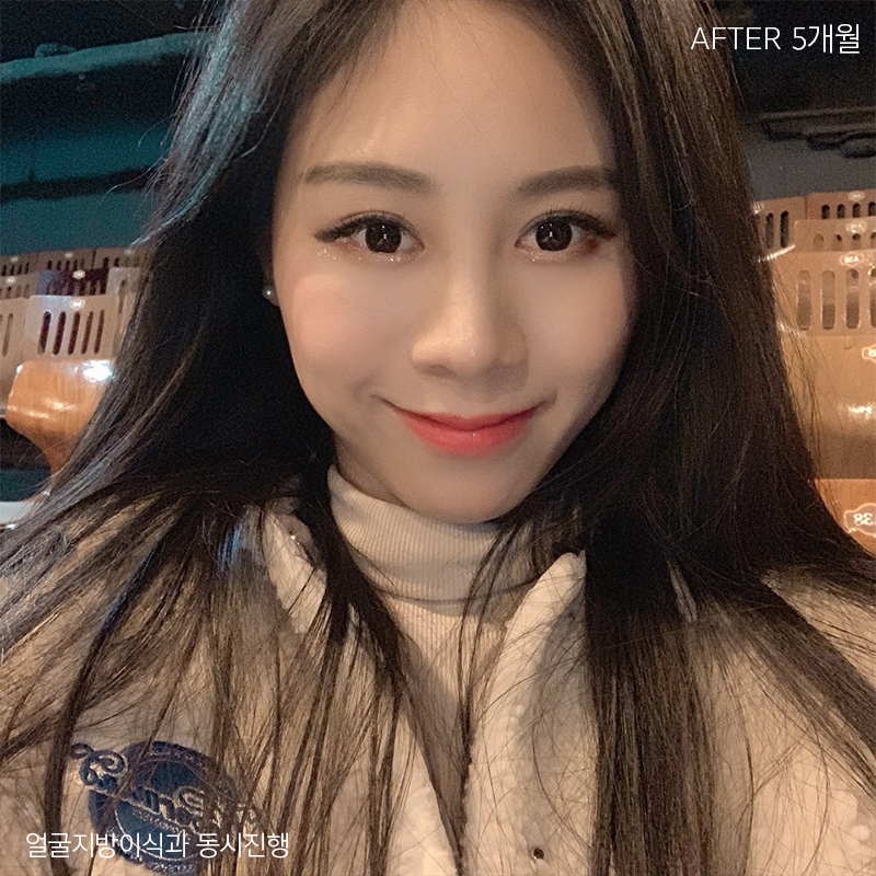 눈밑지방재배치회복과정이 빠를 수밖에 없는 이유 관련 이미지 6