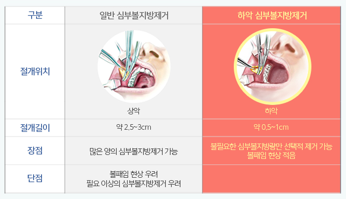 하악심부볼지방제거 어디다? 김형진뉴라인성형외과다! 관련 이미지 5