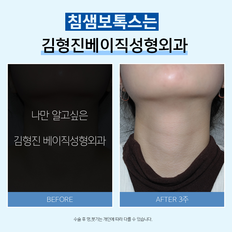 침샘비대증, 이거면 끝! 관련 이미지 4