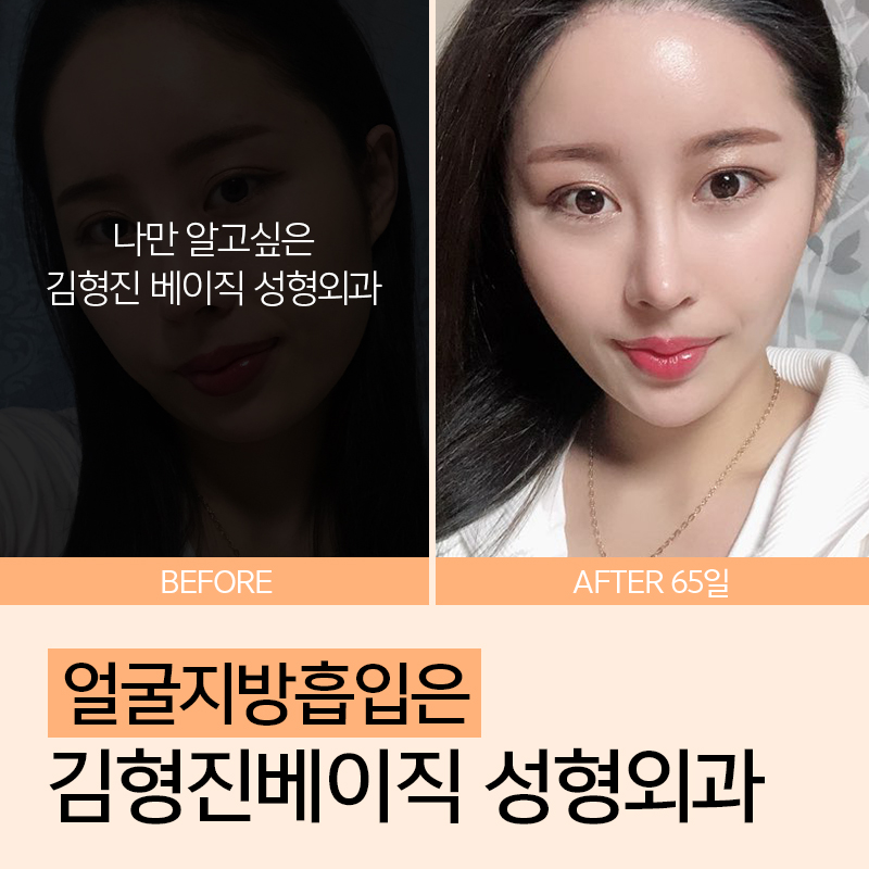 소프트브이라인! 나의 비포애프터가 궁금해 관련 이미지 2