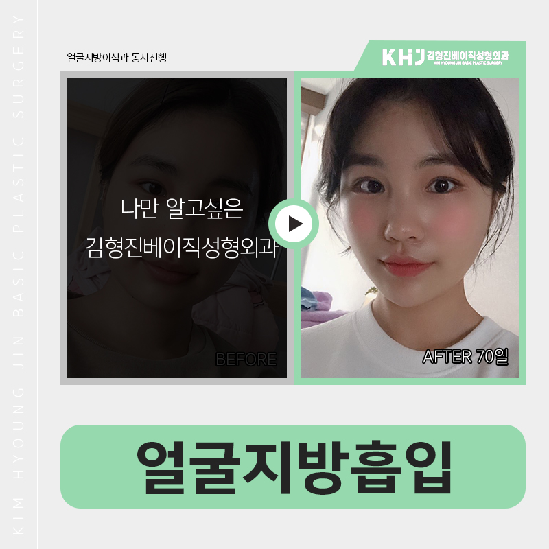 얼굴지방흡입방법 어떻게 진행되냐구요? 관련 이미지 8