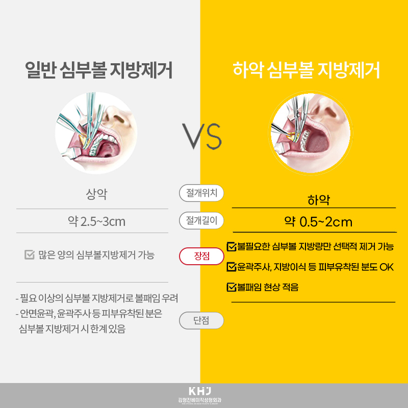 심부볼제거수술 볼패임 없이 할 수 있는 곳? 관련 이미지 5