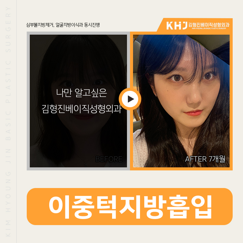 이중턱지방흡입비용 부담되신다구요? 관련 이미지 4