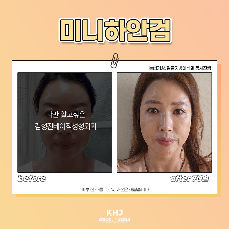 중년눈밑수술 더 이상 미루지 마세요! 관련 이미지 5