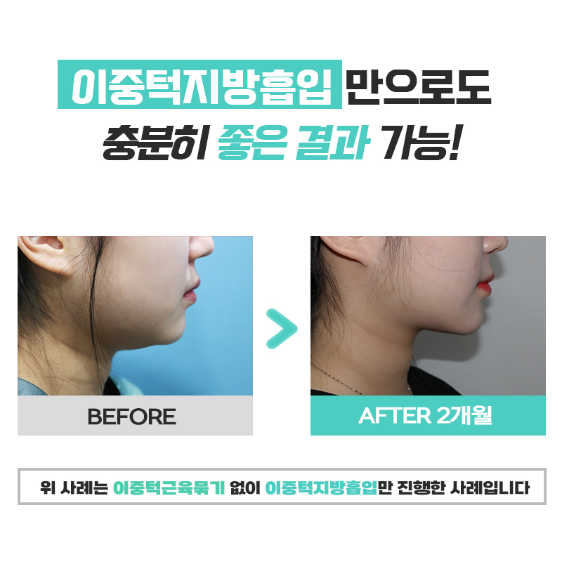 절대 안빠지는 턱살, 이중턱살빼는수술로 극복한 후기 관련 이미지 6