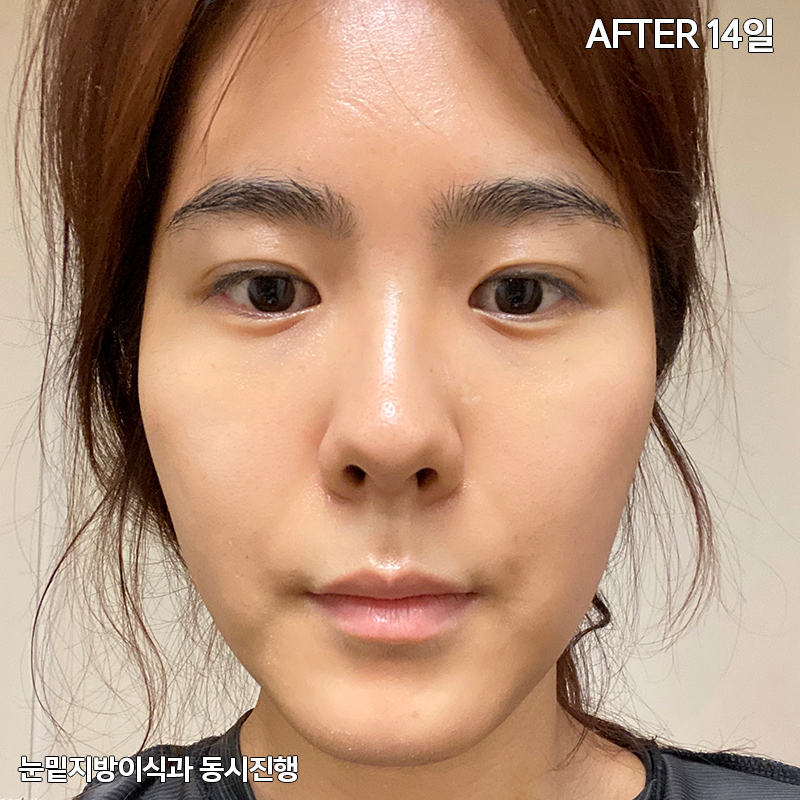 눈밑지방재배치유지력 하면 김형진베이직 관련 이미지 4