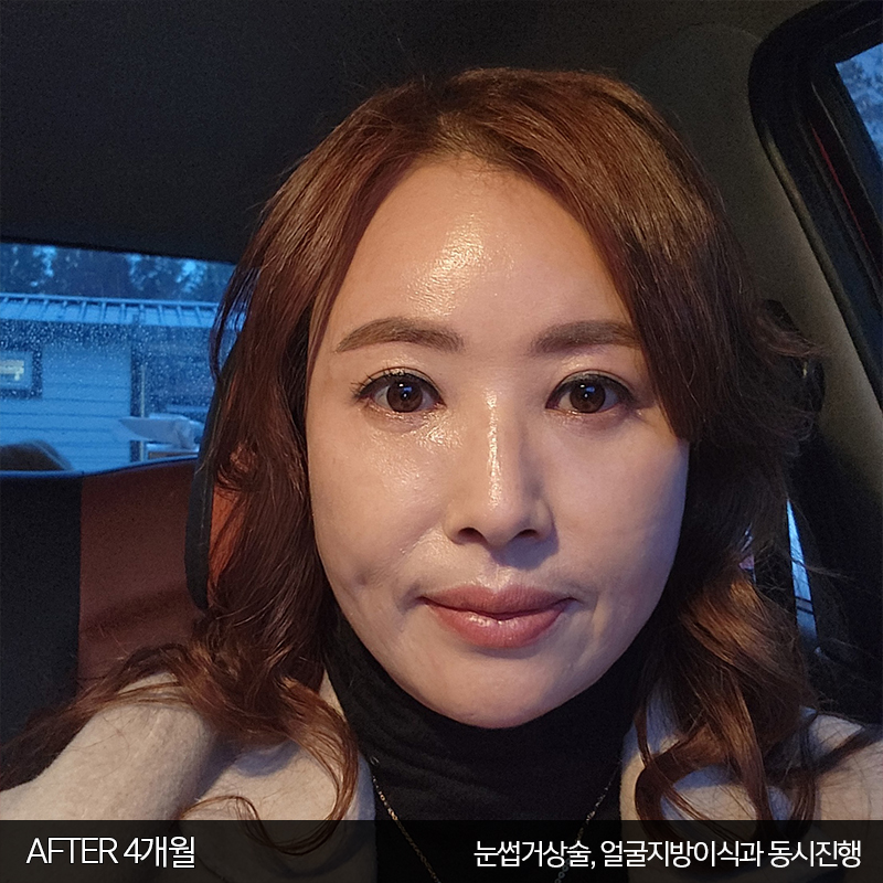 미니하안검수술방법 궁금하시죠? 관련 이미지 5