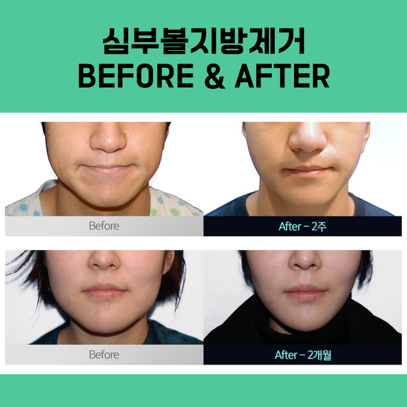 The Hidden Facial Contours Revealed Through Facial Liposuction image 3