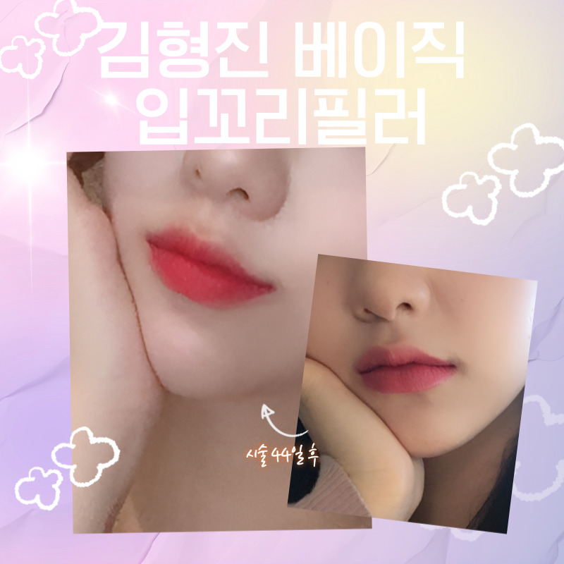 입꼬리필러효과 무표정에도 기분 좋아 보이는 인상으로! 관련 이미지 3