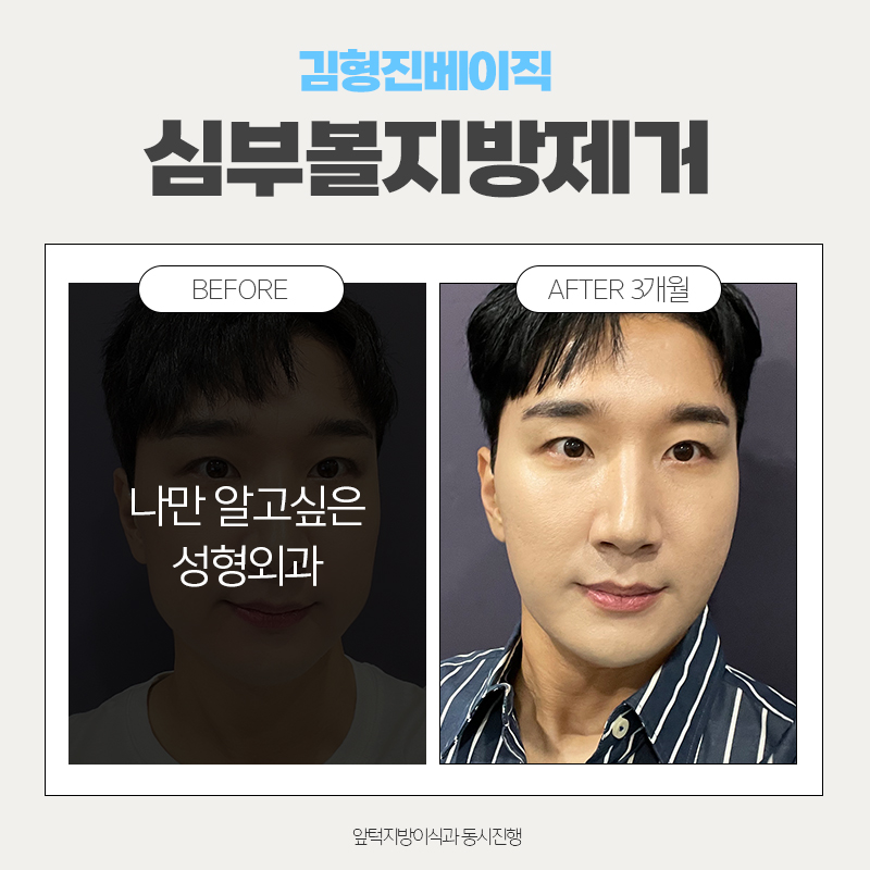 심부볼제거후기 이정도는 돼야죠 관련 이미지 5