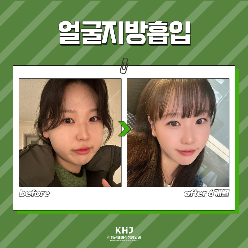 얼굴지방흡입전후 역대급 차이 느끼고 싶다면? 관련 이미지 7