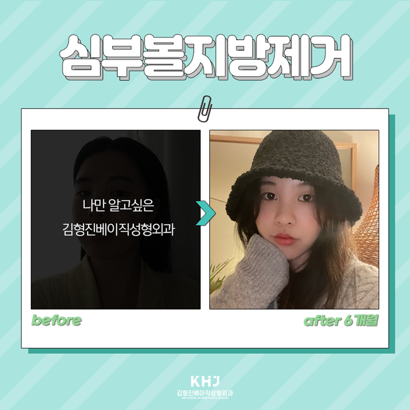 심부볼위치 정확하게 알려드릴게요! 관련 이미지 5