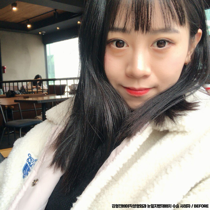 눈밑지방재배치후기 봐줄거죠? 관련 이미지 3