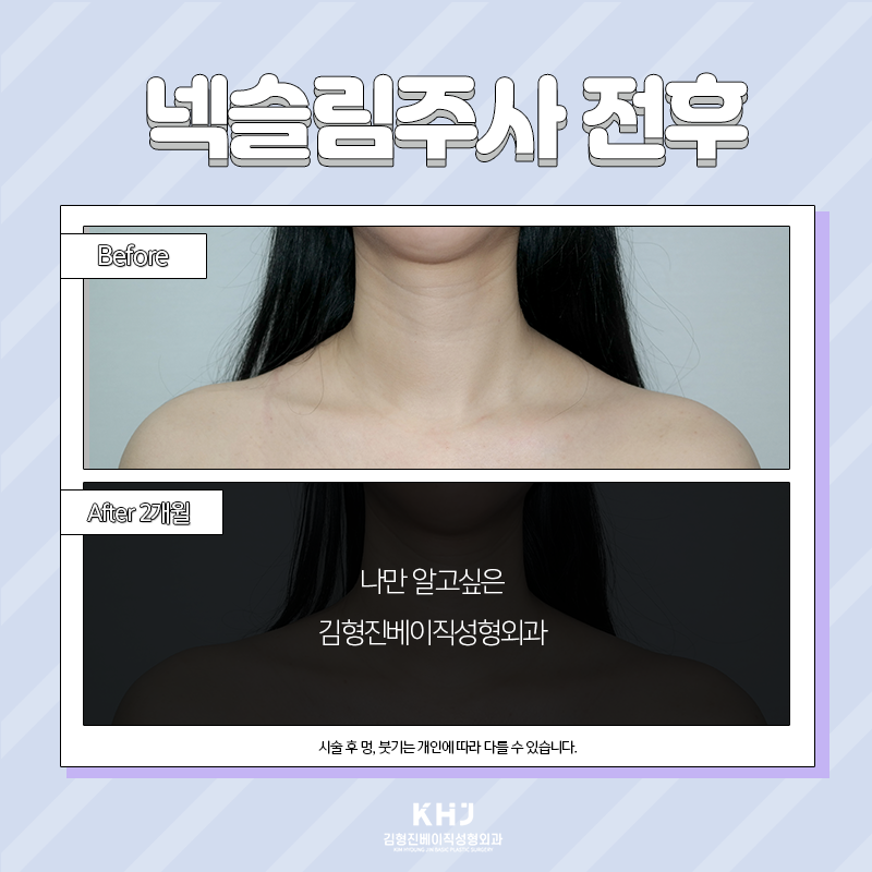 넥슬림주사전후 이렇게나 대단해! 관련 이미지 4