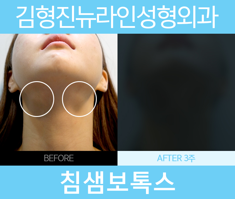 침샘보톡스 확실한 효과를 관련 이미지 3