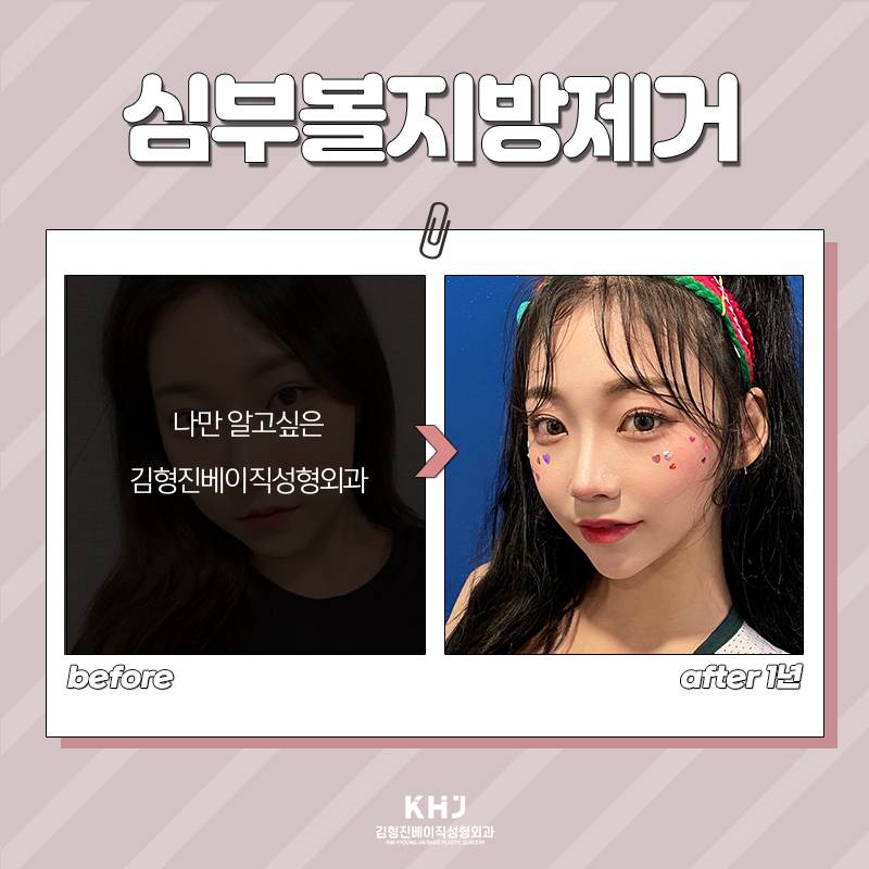 심부볼지방제거후기 보고 가세요! 관련 이미지 6