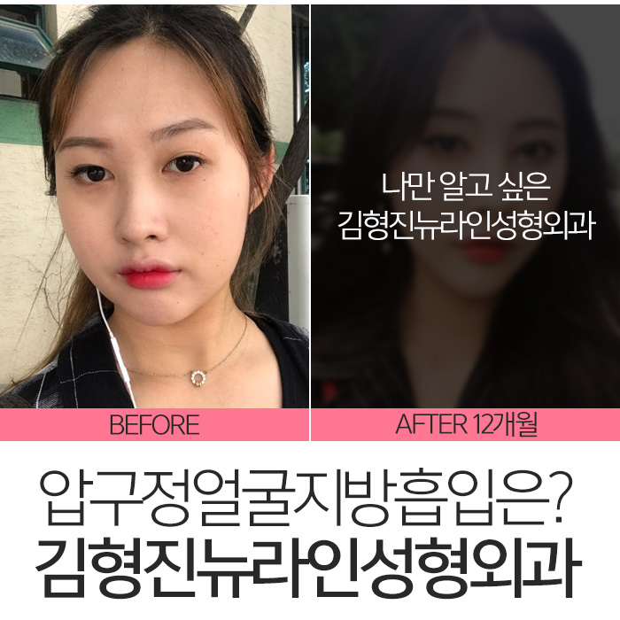 압구정얼굴지방흡입 잘한다고 했죠? 관련 이미지 3
