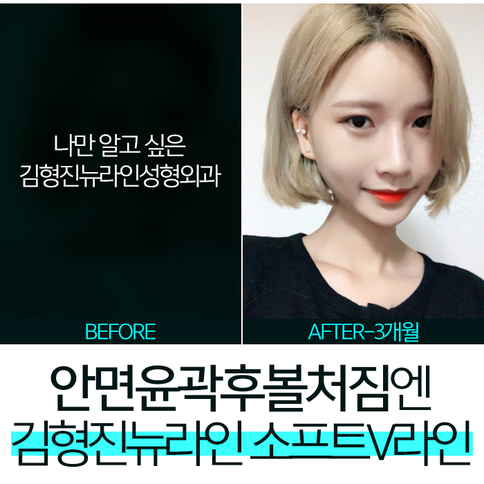 안면윤곽수술후볼처짐 진짜 해결책은 따로 있어! 관련 이미지 1