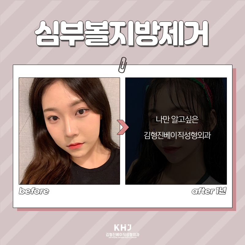 심부볼지방제거후기 보고 가세요! 관련 이미지 5