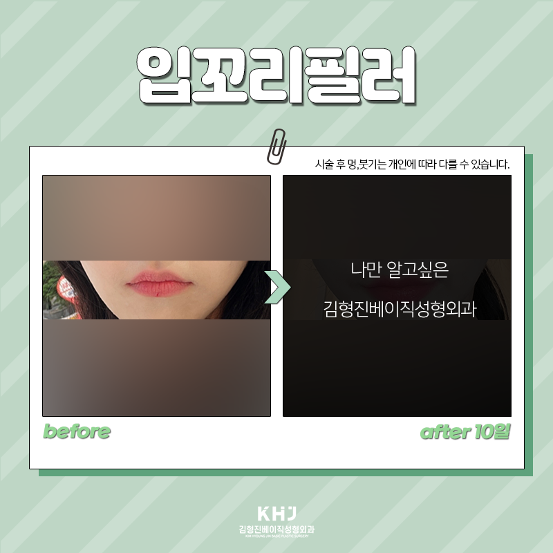 압구정입꼬리필러 어디로 가야할지 궁금하셨죠? 관련 이미지 3