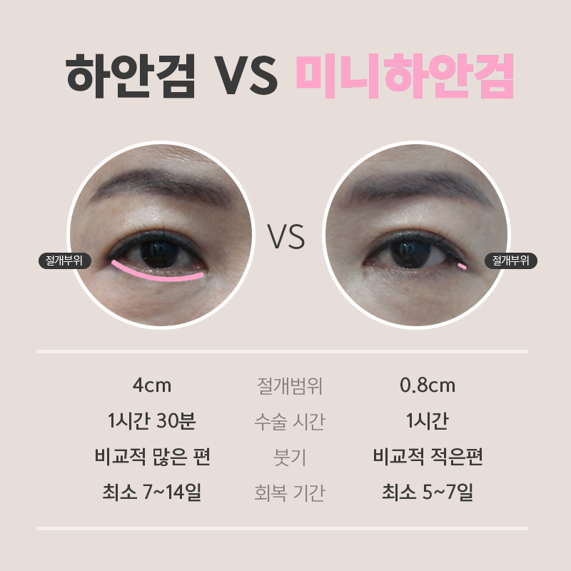 효도성형추천 미니하안검 동안 얼굴 만들어 드리고 싶다면 관련 이미지 4