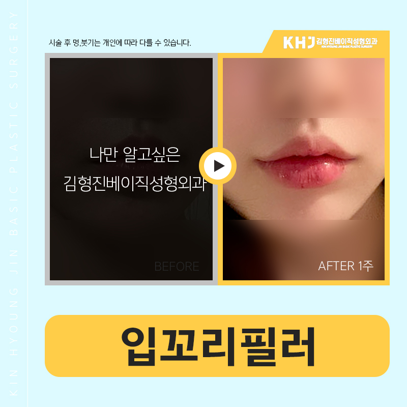 입꼬리필러전후 확실하게 관련 이미지 6