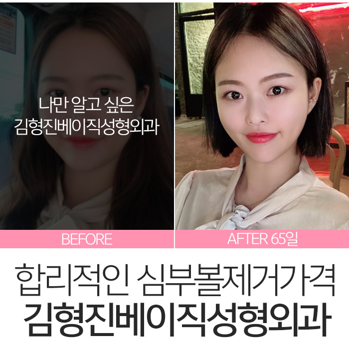 심부볼지방제거가격 싼 곳 보다는 실력이 중요! 관련 이미지 7