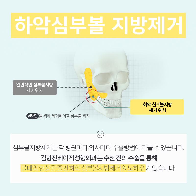 확실하게 얼굴지방없애는법 김형진베이직에서 알게 됐어요 관련 이미지 5