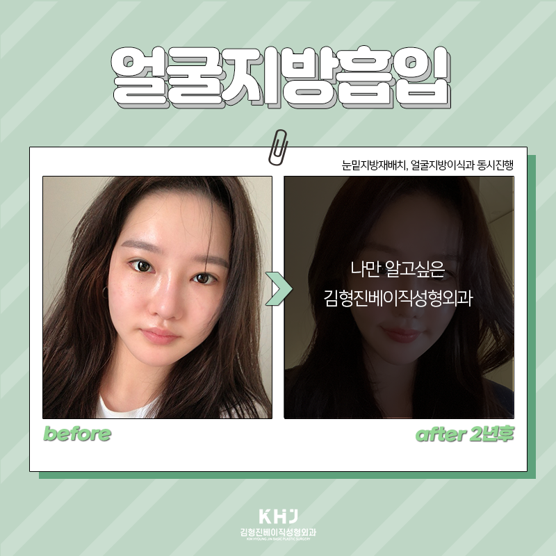 얼굴지방흡입부작용 걱정 되신다면 관련 이미지 5