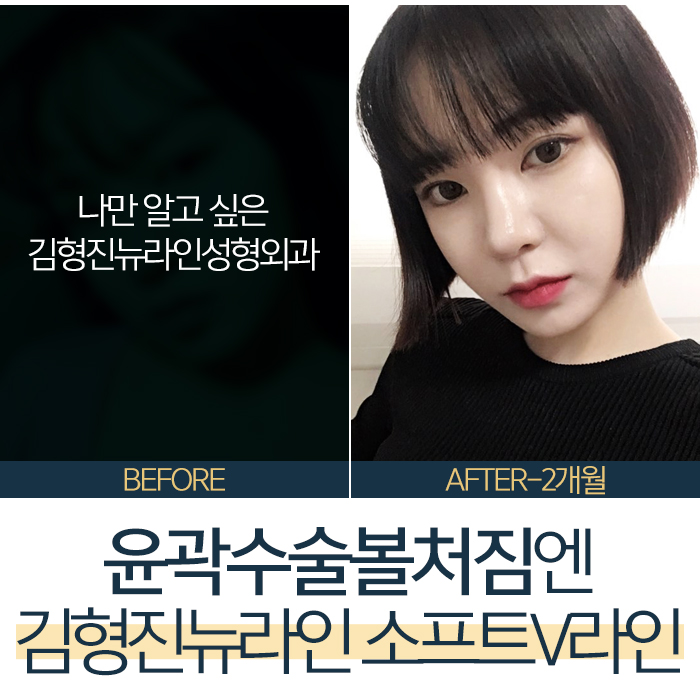 안면윤곽후볼처짐리프팅 아니야 관련 이미지 3