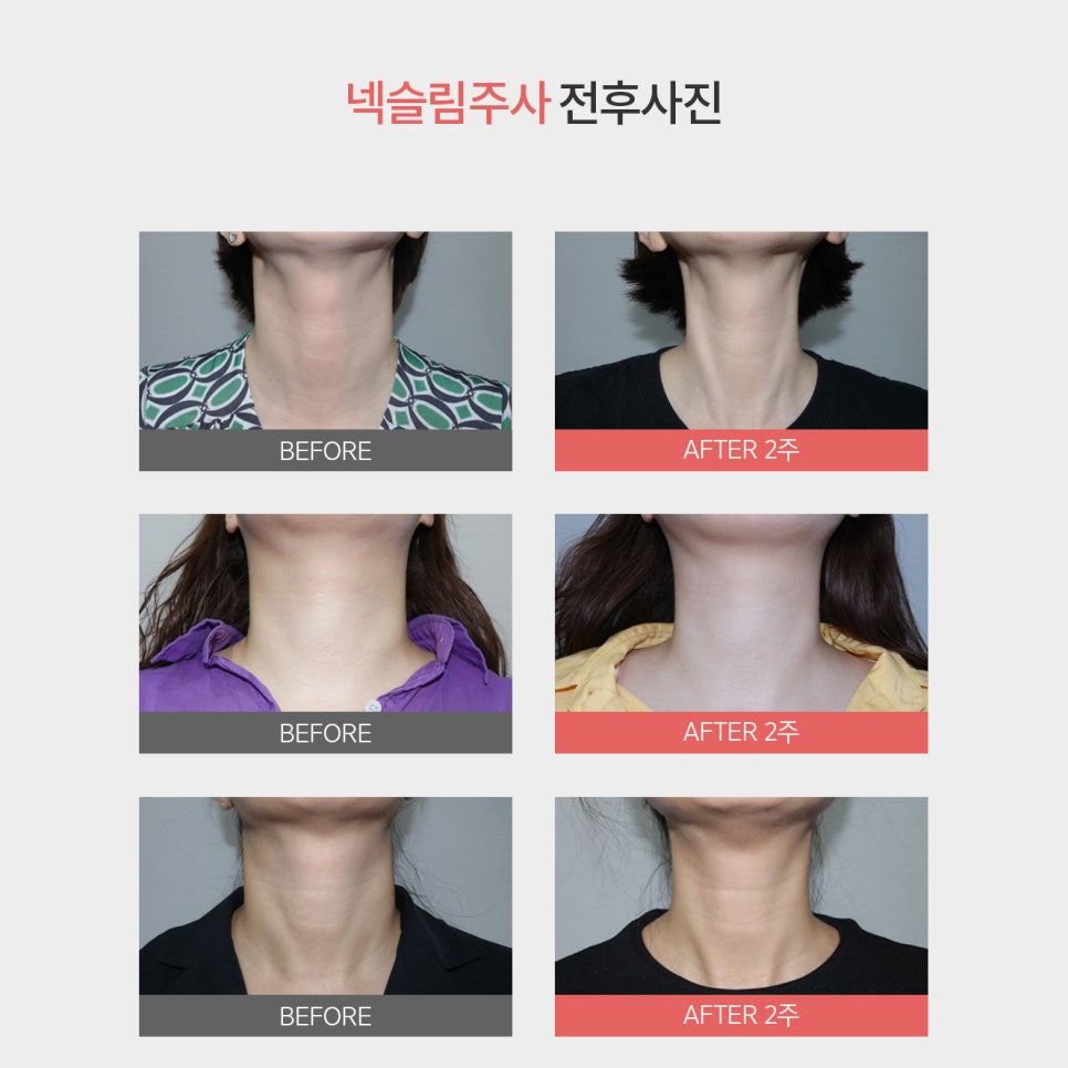 한껏 가벼워진 목선, 넥슬림주사효과로 라인 완성하기 관련 이미지 5