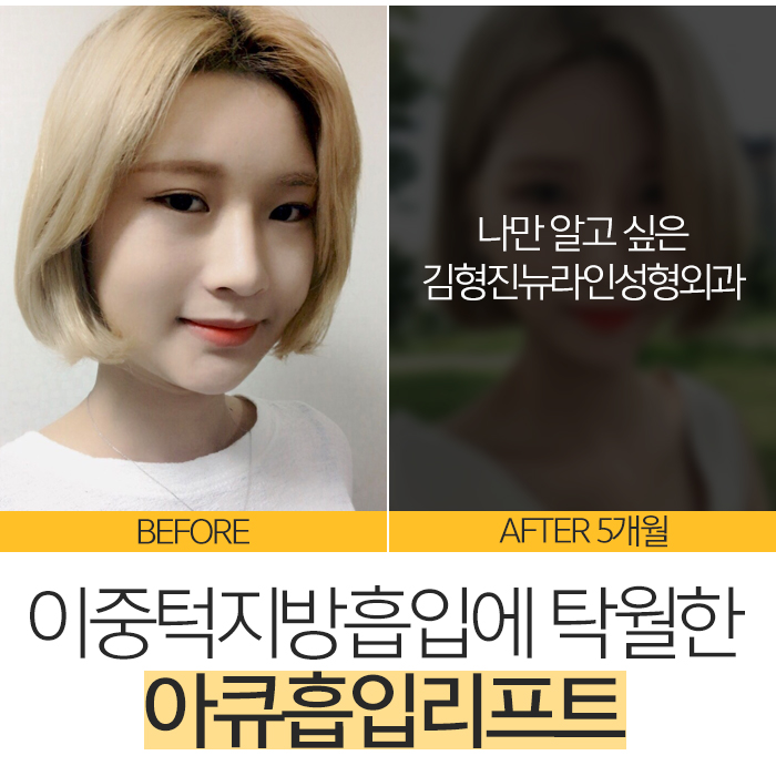 이중턱지방흡입부작용 걱정 없는데 관련 이미지 2
