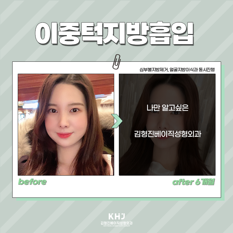 이중턱지방흡입효과 정말 대단해! 관련 이미지 2