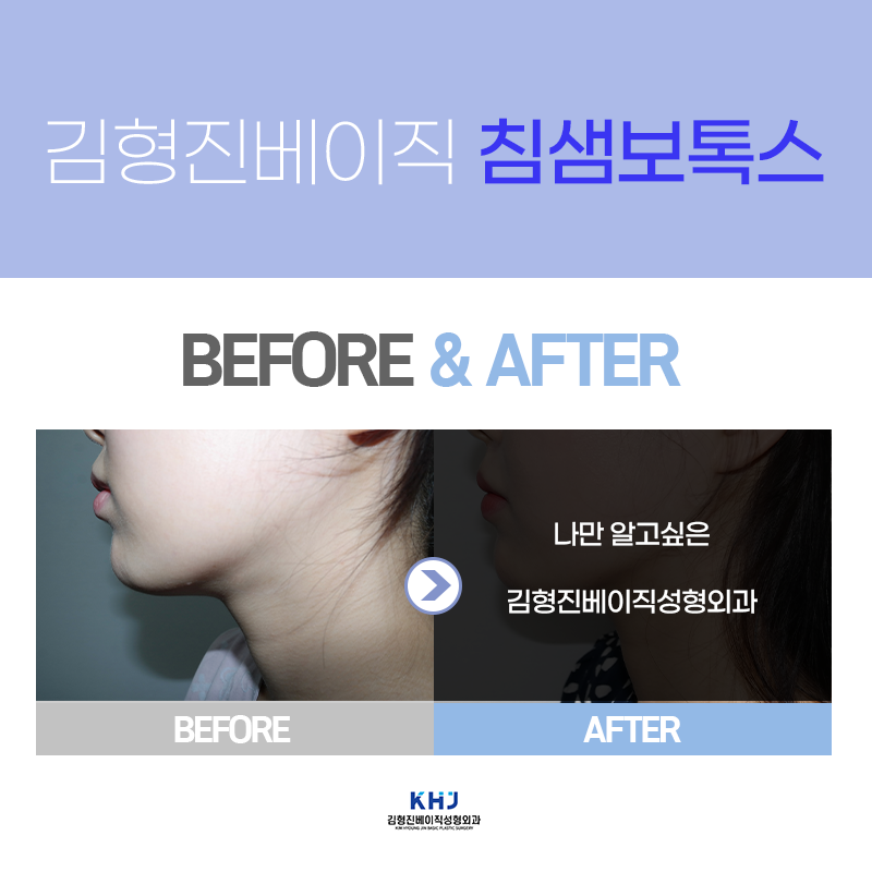 침샘보톡스전후 궁금하시다구요? 관련 이미지 3