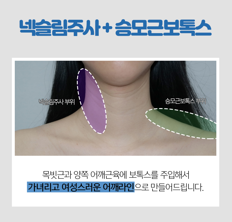 넥슬림보톡스 누가 해야되냐면요 관련 이미지 3