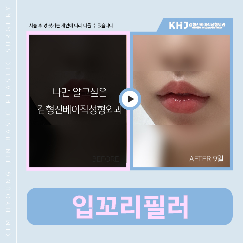 압구정입꼬리필러 잘하는 곳 찾고 있다면 관련 이미지 6