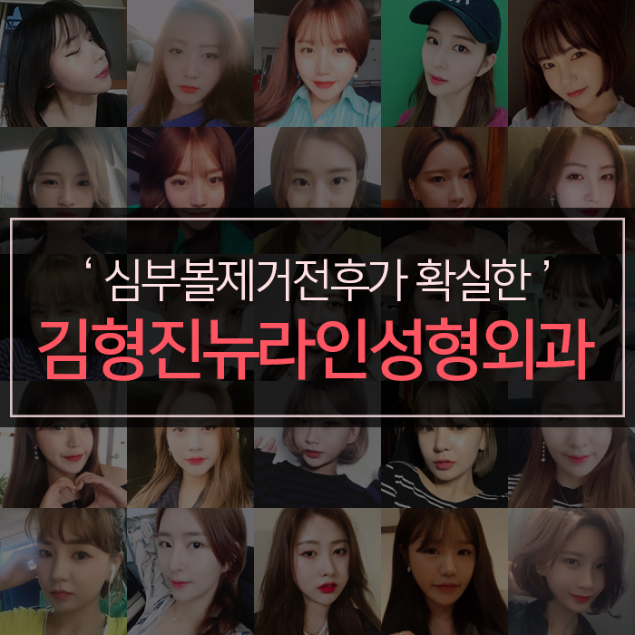 심부볼제거전후 김형진뉴라인성형외과에서 관련 이미지 7