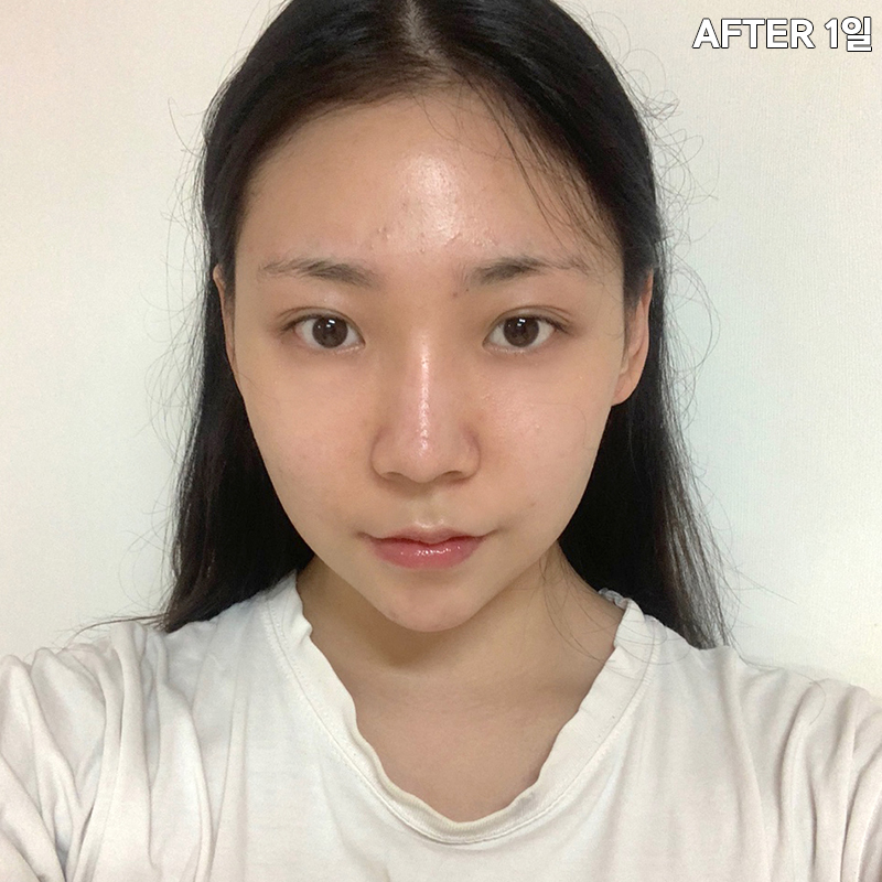 심부볼제거수술을 왜 받냐구요? 관련 이미지 3