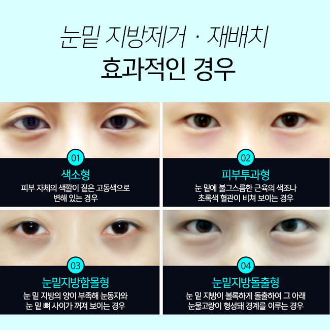 눈밑지방제거가격보다 중요한건 ? 관련 이미지 3
