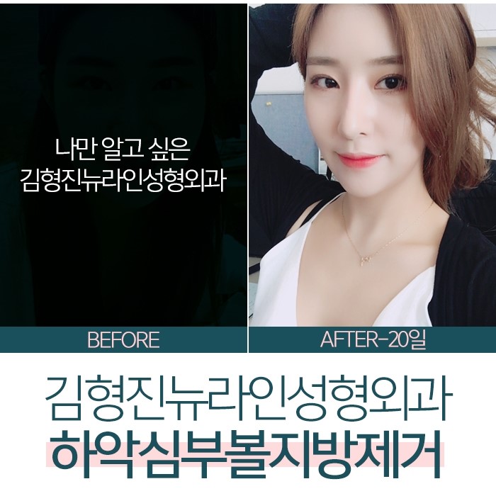 심부볼제거후기 진짜를 보여주지 관련 이미지 7