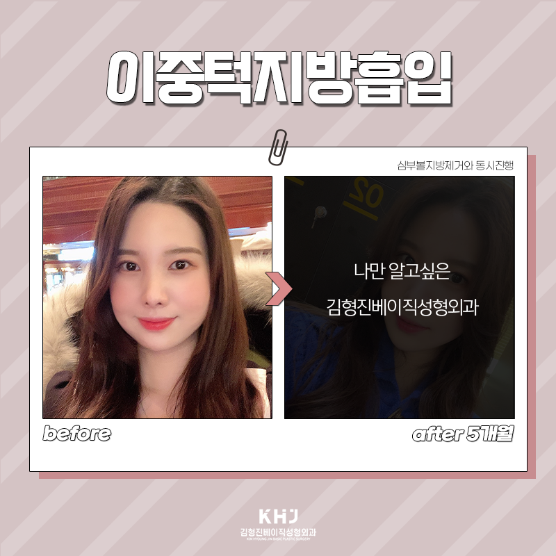 턱라인지방흡입 전후 차이 대단해! 관련 이미지 5