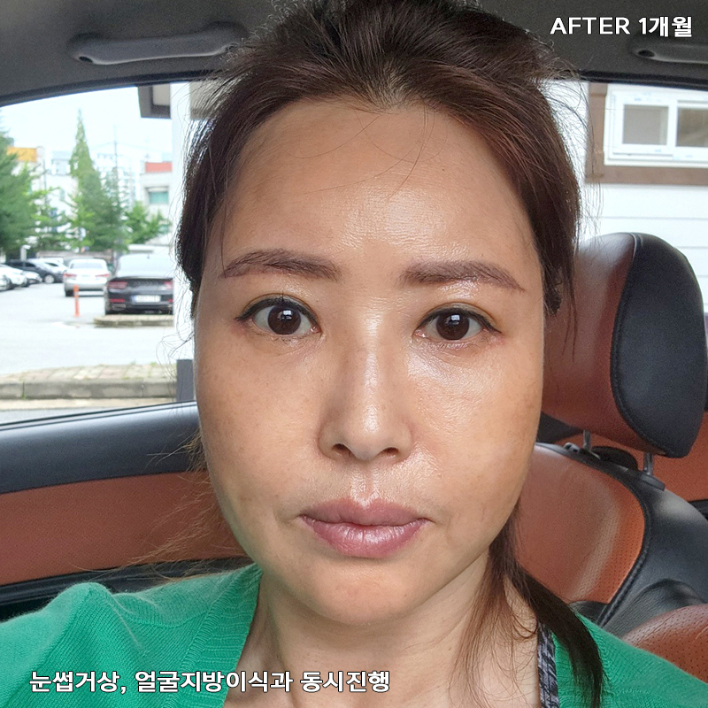 중년눈밑지방개선 어떤 방법이 있냐구요? 관련 이미지 3