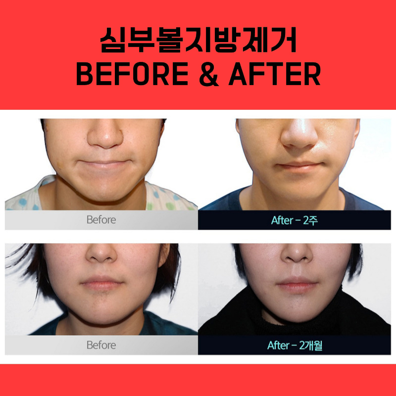 It Seems Like Not Everyone Knows About This Deep Cheek Fat Removal Method... image 5