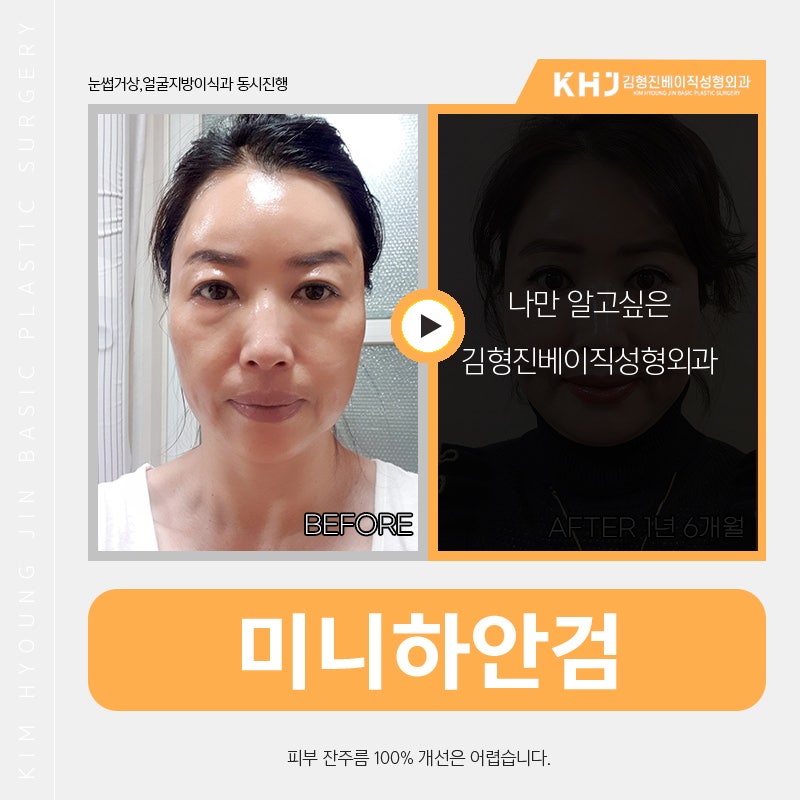 효도성형추천 변화가 확실한 김형진베이직의 미니하안검 관련 이미지 5