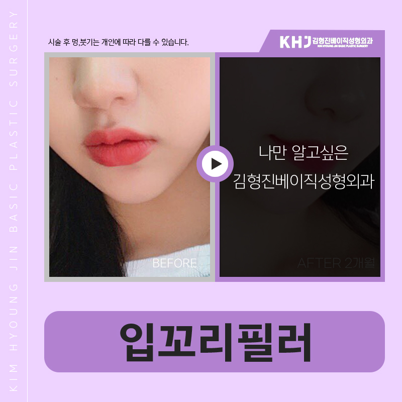 입꼬리필러효과 무표정에도 기분 좋아 보이는 인상으로! 관련 이미지 5