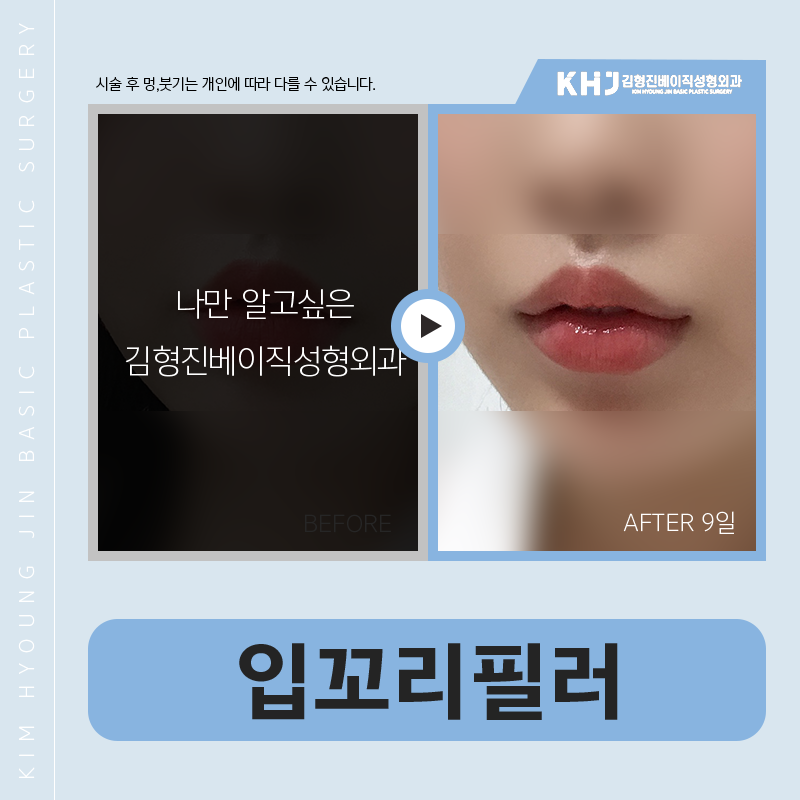 입꼬리필러모양 세심하게 잡아주는 곳 찾으신다면? 관련 이미지 4