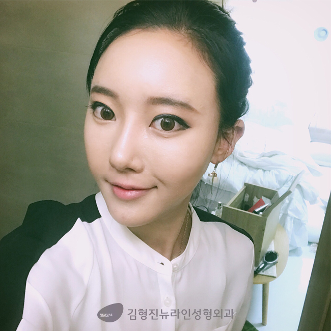 입꼬리수술비용 보다 효율적인 방법은? 관련 이미지 3