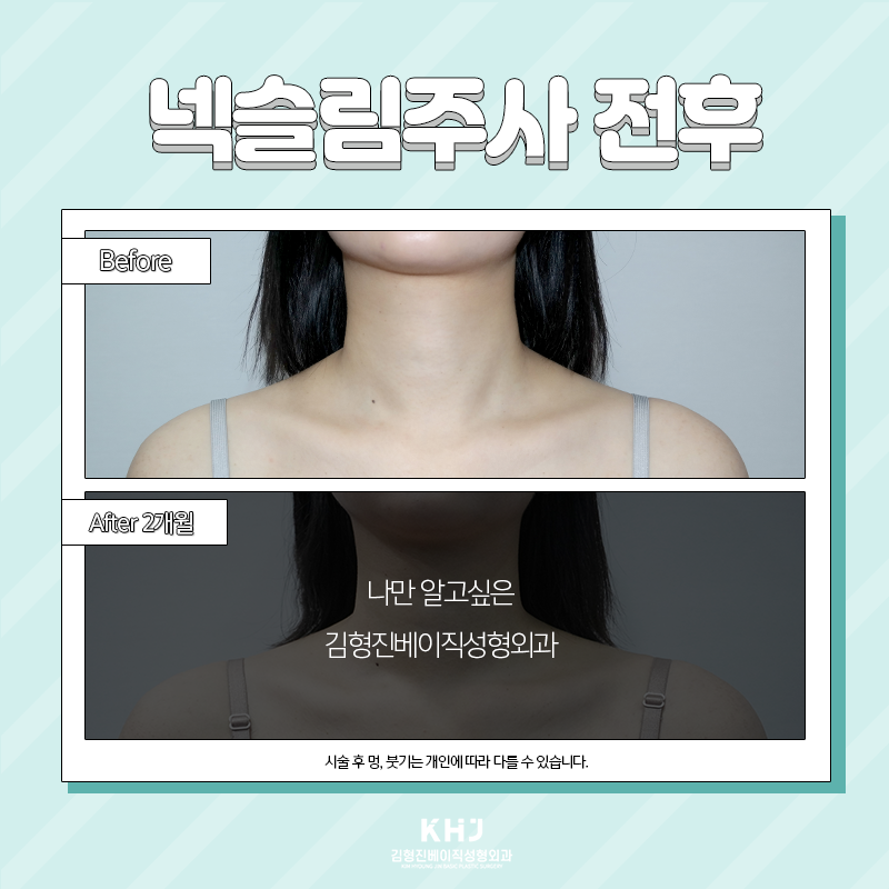 넥슬림주사전후 확인하고 가세요~! 관련 이미지 3