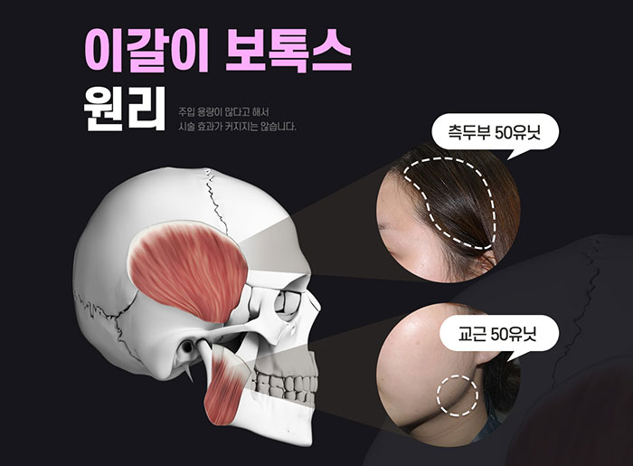 이갈이보톡스 간단하다 간단해 관련 이미지 3