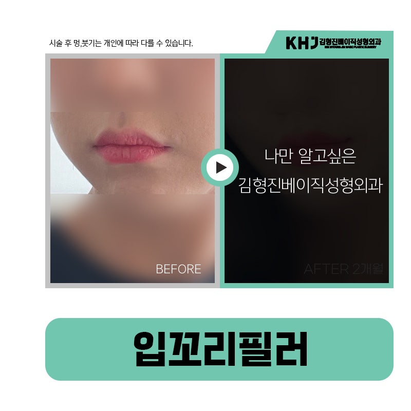 입꼬리필러전후 보고 여기로 마음 굳혔어요! 관련 이미지 5